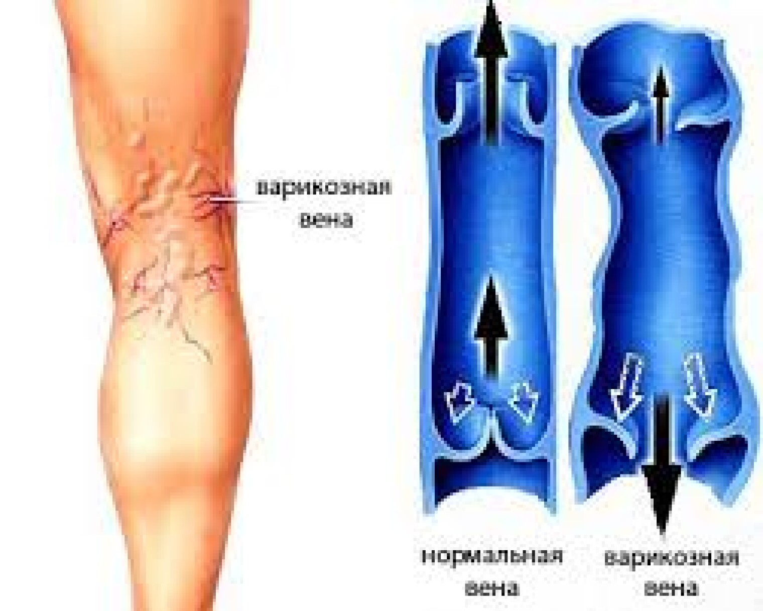 Варикозное расширение вен конечностей. Варикозная болезнь вен. Варикозно расширенные вены нижних конечностей. Варикозное расширение вен нижних конечностей рисунок.
