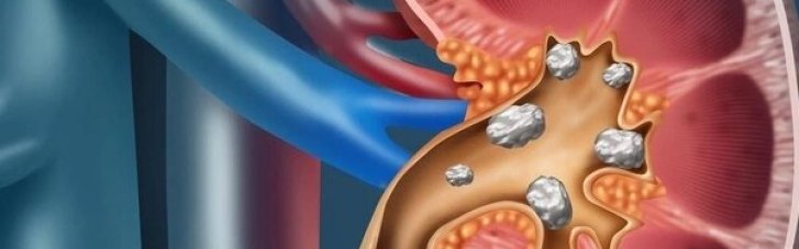 Камені в нирках: медики назвали небезпечні продукти